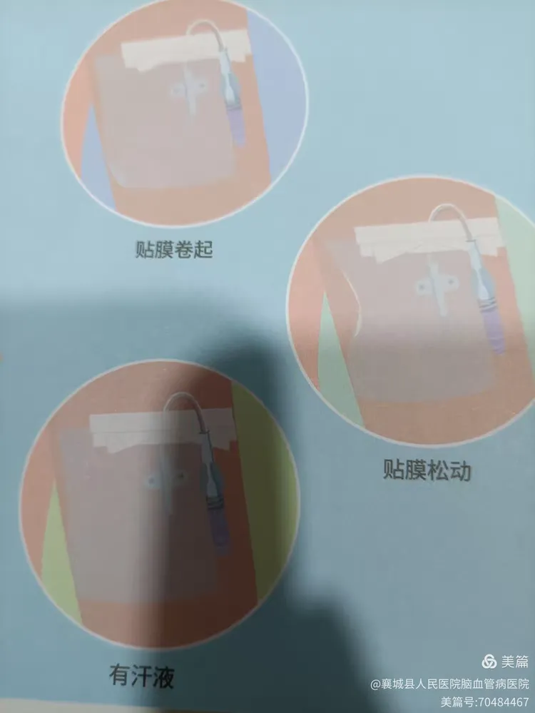 改良型中长导管